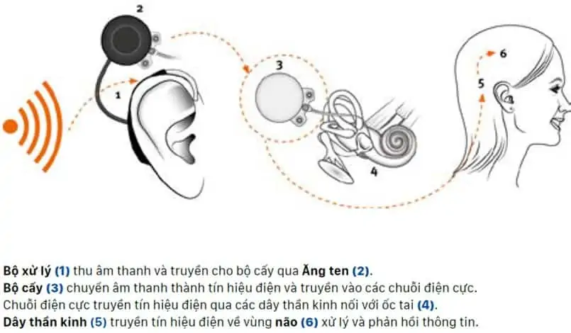 4 - Ốc tai điện tử, điện cực ốc tai là gì và hoạt động ra sao?